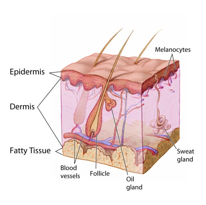 Acne Vulgaris